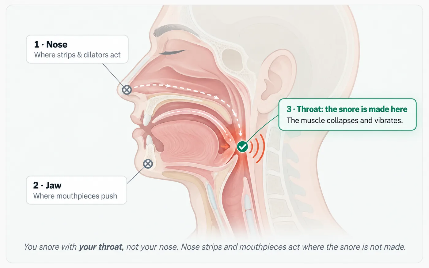 Cross-section of the head showing where each type of snoring device acts versus where the snore is actually made